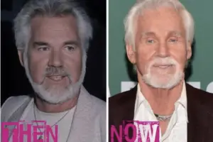 Kenny Rogers Plastic Surgery, Before and After