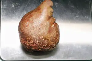 Largest kidney stones